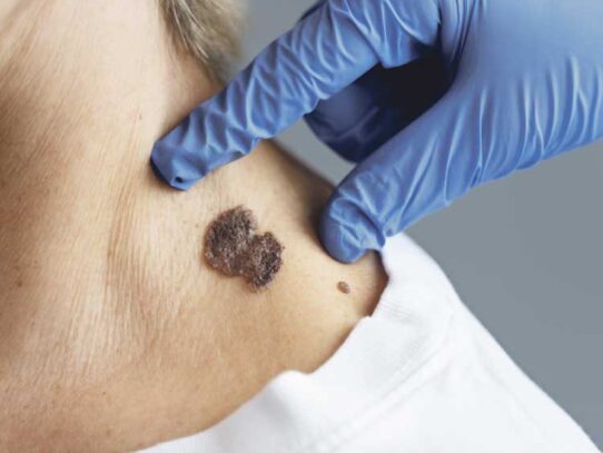 ¡Tómelo en serio! hay que estar atento a los lunares