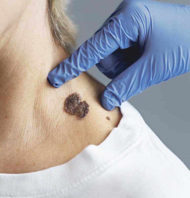 ¡Tómelo en serio! hay que estar atento a los lunares